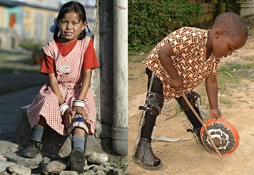 Dankzij een prothese kunnen deze kinderen nu gewoon naar school